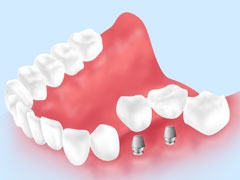 インプラント、入れ歯、ブリッジいずれの治療にも対応しているか